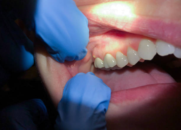 Best Broken or Cracked Tooth Emergency Dentist in Kitsap Lake, WA