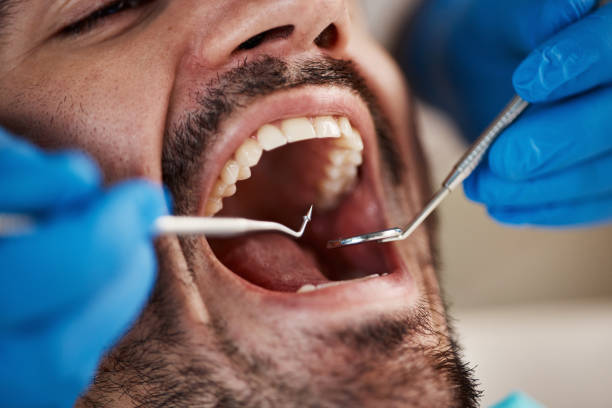 Best Emergency Dentist for Knocked-Out Tooth in Kitsap Lake, WA