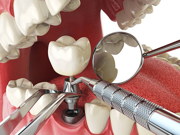 Best Emergency Dentist for Lost Fillings or Crowns in Kitsap Lake, WA